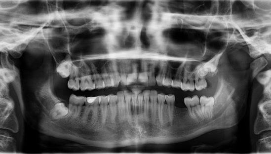 Dental Implants