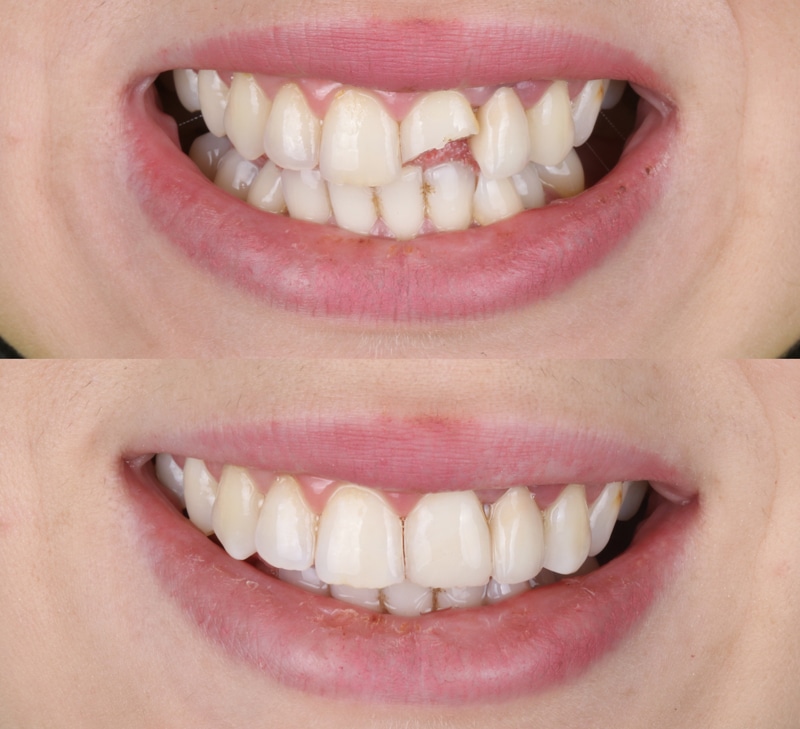 Two close-up photos of a smiling mouth: top shows a chipped front tooth, bottom shows the same teeth repaired and smooth.