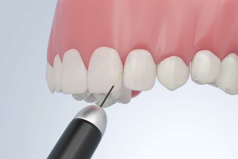 A close-up illustration of a dental laser device being applied to the gum line near the upper front teeth during a dental procedure.