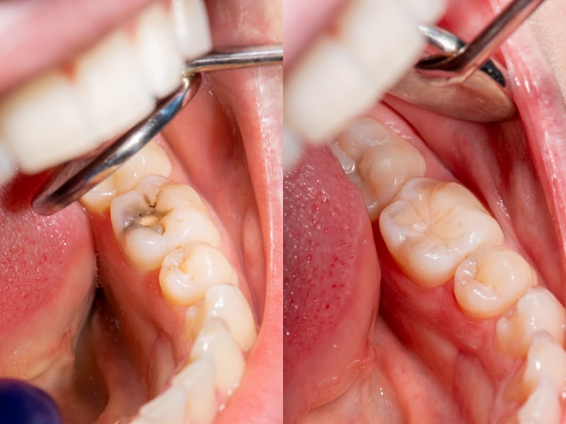 Side-by-side close-up images of a molar before and after treatment: left shows a cavity, right shows the tooth filled and smooth.