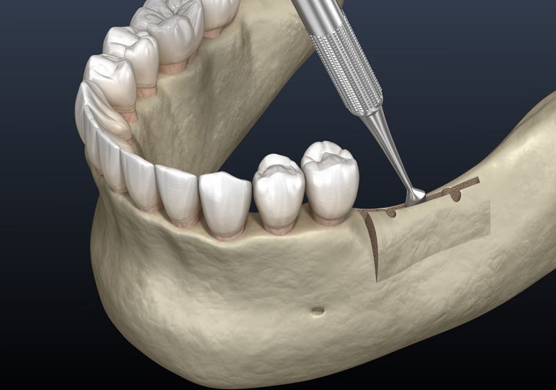 3D illustration of a dental procedure with a tool lifting a gum flap from the lower jawbone, exposing bone and teeth below.