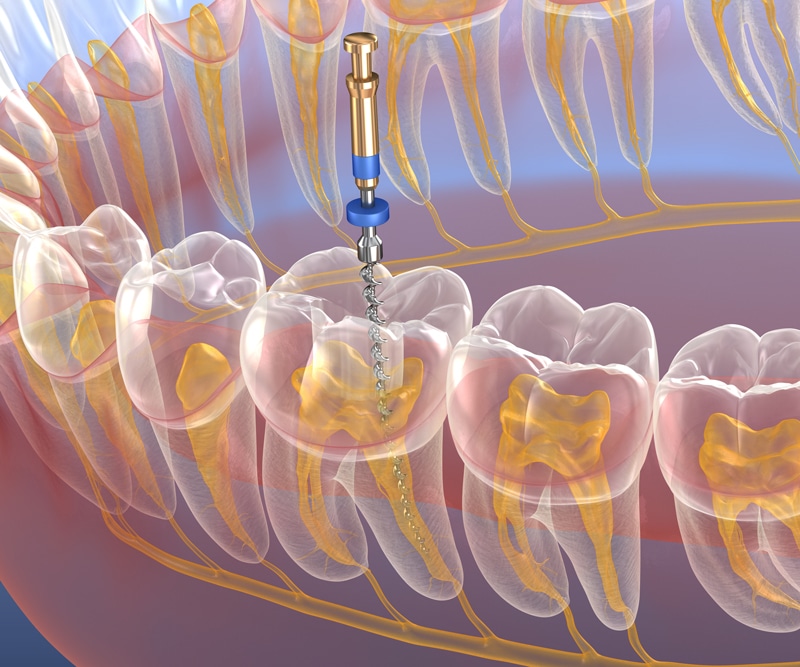 A 3D illustration of a dental tool cleaning a molar during a root canal, with transparent teeth showing nerves and roots inside the jaw.