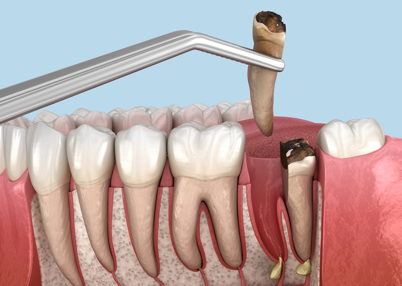 3D illustration of dental extraction showing a decayed molar being pulled with forceps from red gum; other teeth are visible.