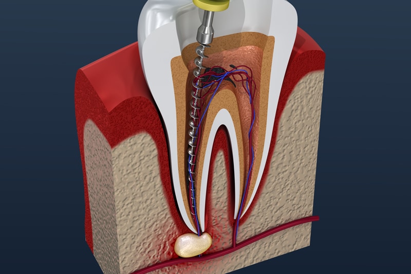 Cross-section of a tooth with a dental file in the root canal, showing nerves, blood vessels, infection at tip, gum and bone.