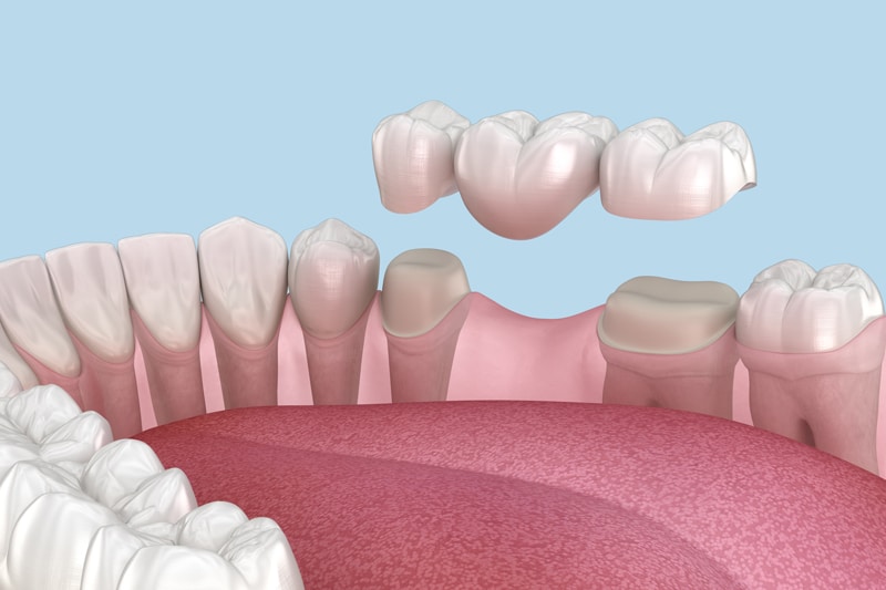 A 3D illustration of a dental bridge above two prepared teeth with a missing tooth gap in between, ready for placement in the lower jaw.