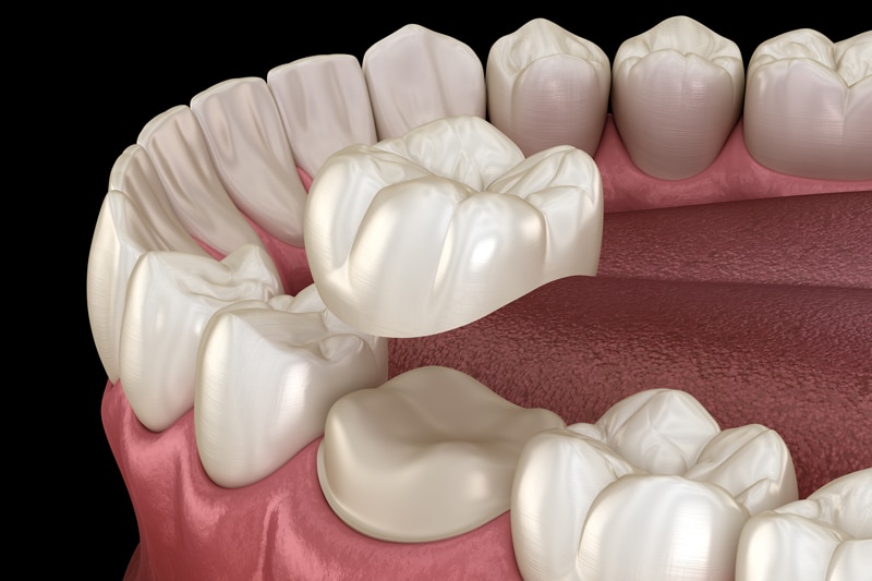 A 3D illustration displays a dental crown being placed on a lower molar tooth, with nearby teeth and gums shown for context.