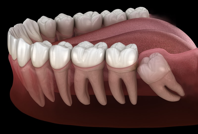 A 3D illustration of a human lower jaw displays teeth and gums, with an impacted wisdom tooth pushing sideways against a molar.